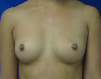 Breast Augmentation Implants Before & After Patient #7407