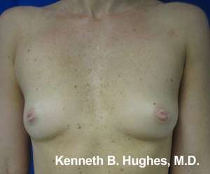 Breast Augmentation Implants Before & After Patient #7410