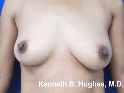Breast Augmentation Implants Before & After Patient #7413