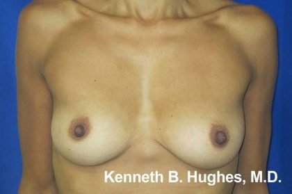 Breast Augmentation Implants Before & After Patient #7416