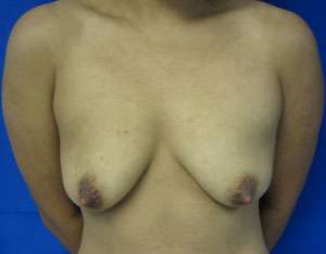 Breast Augmentation Implants Before & After Patient #7419