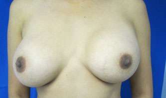 Breast Augmentation Implants Before & After Patient #7428