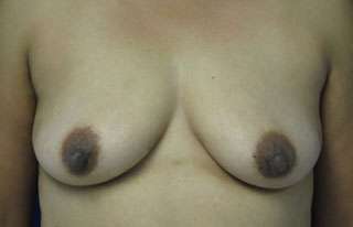 Breast Augmentation Implants Before & After Patient #7437