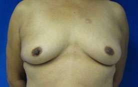 Breast Augmentation Implants Before & After Patient #7443