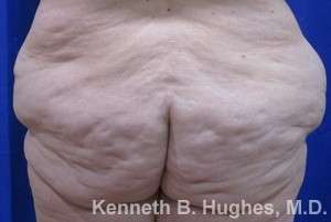 Body Lift Before & After Patient #6012