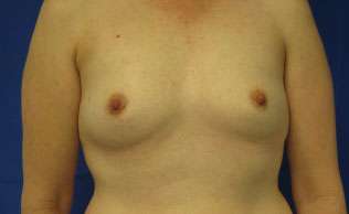 Breast Augmentation Implants Before & After Patient #7455