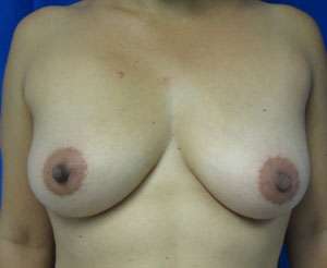 Breast Augmentation Implants Before & After Patient #7476