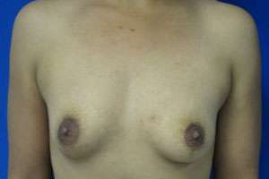 Breast Augmentation Implants Before & After Patient #7482