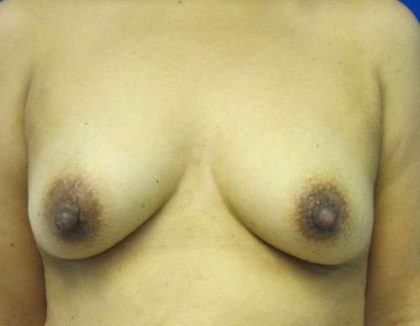 Breast Augmentation Implants Before & After Patient #7485