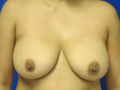 Breast Augmentation Implants Before & After Patient #7488