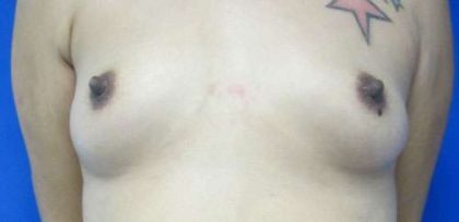 Breast Augmentation Implants Before & After Patient #7497