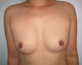 Breast Augmentation Implants Before & After Patient #7500