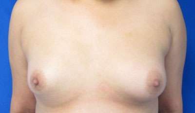 Breast Augmentation Implants Before & After Patient #7506