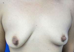 Breast Augmentation Implants Before & After Patient #7509