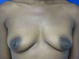 Breast Augmentation Implants Before & After Patient #7512