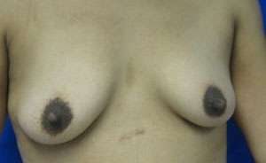 Breast Augmentation Implants Before & After Patient #7518