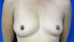 Breast Augmentation Implants Before & After Patient #7524