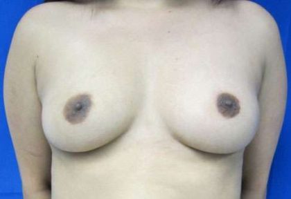 Breast Augmentation Implants Before & After Patient #7527