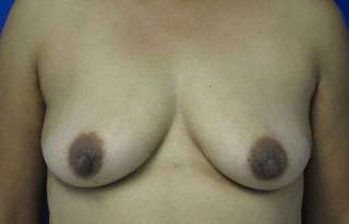 Breast Augmentation Implants Before & After Patient #7530