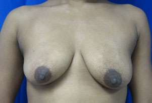 Breast Augmentation Implants Before & After Patient #7533