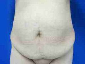 Body Lift Before & After Patient #6023