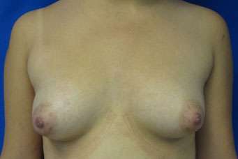 Breast Augmentation Implants Before & After Patient #7536