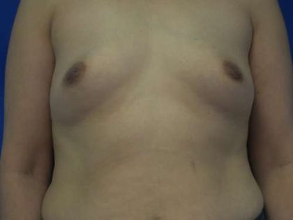 Breast Augmentation Implants Before & After Patient #7542