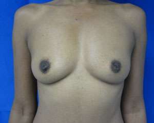 Breast Augmentation Implants Before & After Patient #7545