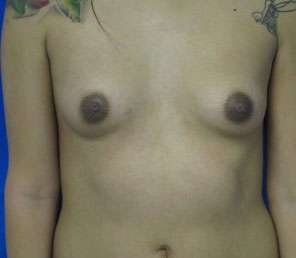 Breast Augmentation Implants Before & After Patient #7548