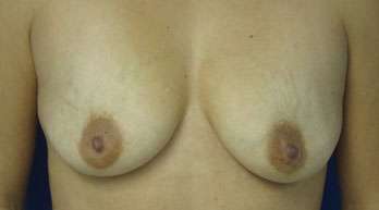 Breast Augmentation Implants Before & After Patient #7551