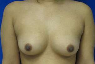 Breast Augmentation Implants Before & After Patient #7557