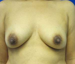 Breast Augmentation Implants Before & After Patient #7560