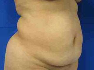 Body Lift Before & After Patient #6026