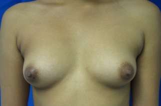 Breast Augmentation Implants Before & After Patient #7566