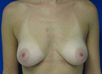 Breast Augmentation Implants Before & After Patient #7569