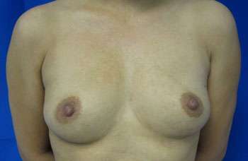 Breast Augmentation Implants Before & After Patient #7572