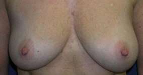 Breast Augmentation Implants Before & After Patient #7586
