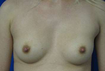 Breast Augmentation Implants Before & After Patient #7589