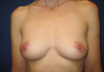Breast Augmentation Implants Before & After Patient #7592