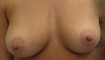 Breast Augmentation Implants Before & After Patient #7595