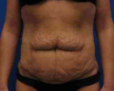 Body Lift Before & After Patient #6029