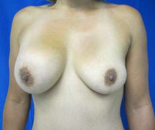 Breast Augmentation Implants Before & After Patient #7601