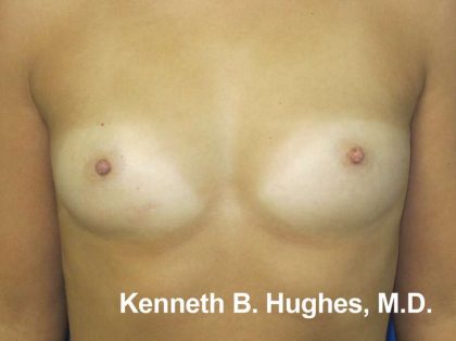 Breast Augmentation Implants Before & After Patient #7604