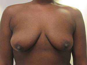 Breast Augmentation Implants Before & After Patient #7611