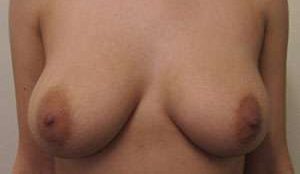 Breast Augmentation Implants Before & After Patient #7618