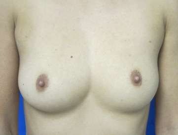 Breast Augmentation Implants Before & After Patient #7621