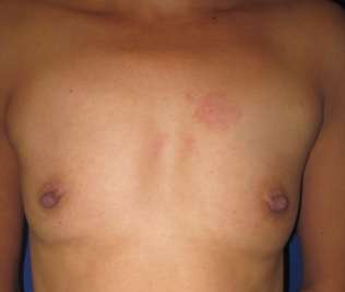 Breast Augmentation Implants Before & After Patient #7624