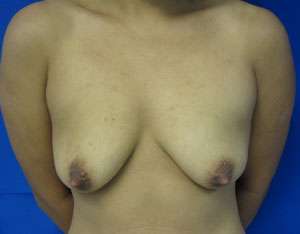 Breast Augmentation Revision Before & After Patient #7630