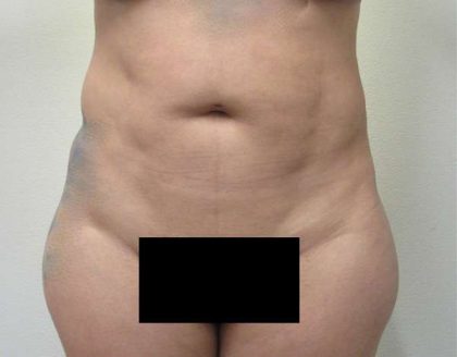 Bodytite Before & After Patient #6032
