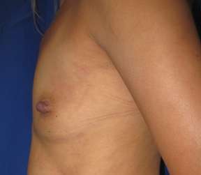 Breast Augmentation Revision Before & After Patient #7636